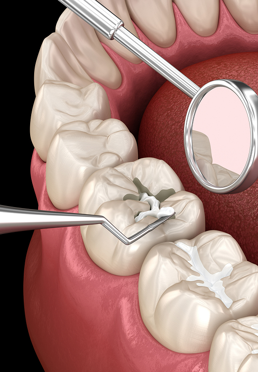 Dental Sealants Banner