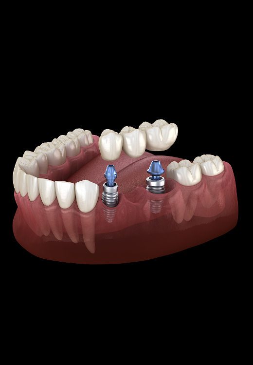 Implant-Supported Bridges Banner