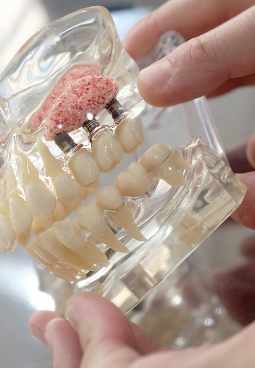 Bone Grafting & Sinus Lifts Banner