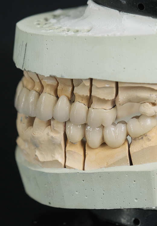 Metal-Free Crowns Banner