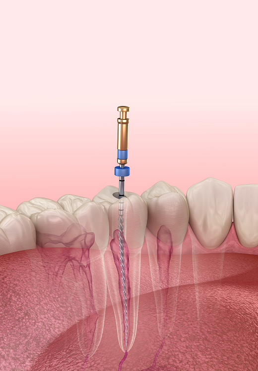 Root Canal Therapy Banner