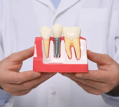 Dental Implants