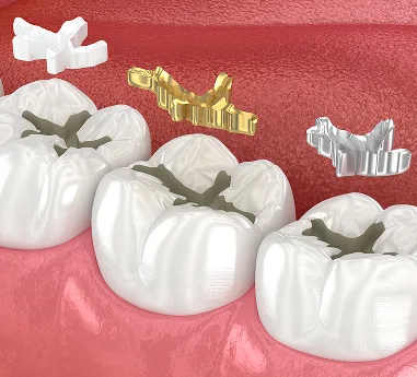 Tooth-Colored Fillings